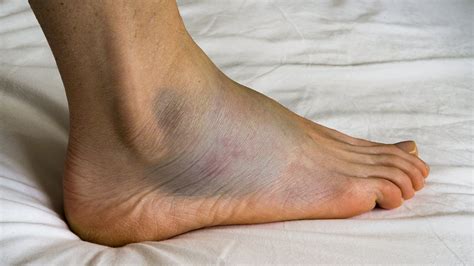 Pain on Top of Foot: 5 Causes, Swelling, Treatment 